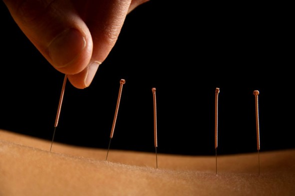 acupunctura