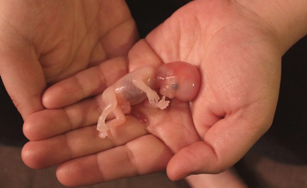avorton-copil-fetus
